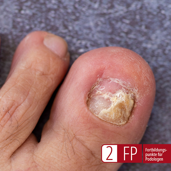 webinar_nagelpilz_94323_01-2025