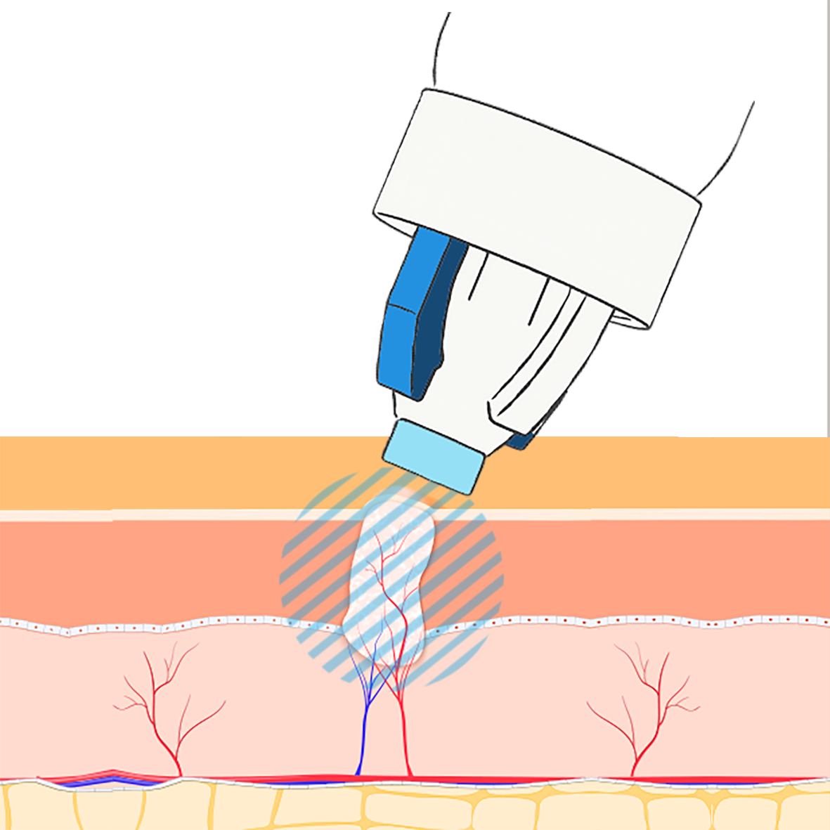 warzenvereiserspray_10925_7